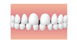 空隙歯列(くうげきしれつ)